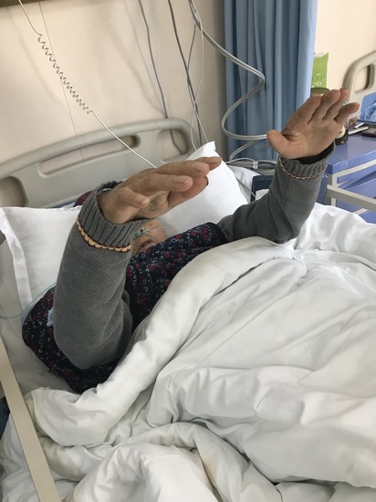 我院卒中中心救治團隊成功為一例高齡重癥腦卒中 患者行腦血管介入取栓手術(圖3)