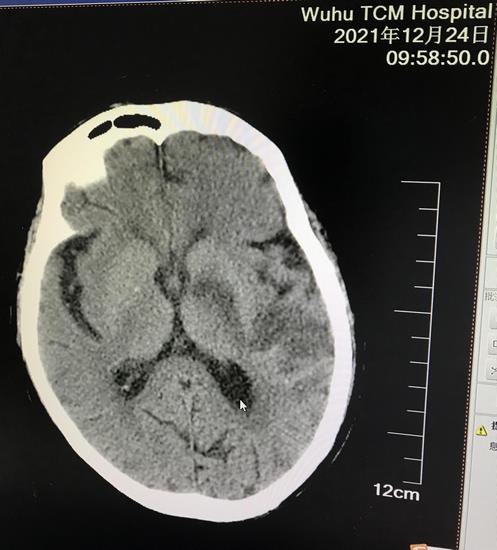 我院卒中中心救治團隊成功為一例高齡重癥腦卒中 患者行腦血管介入取栓手術(圖4)
