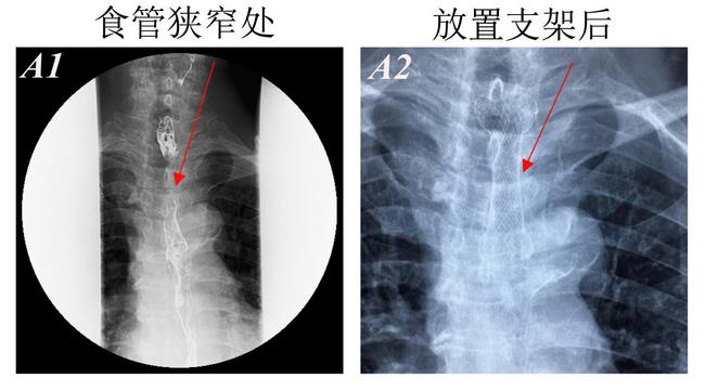 消化科運(yùn)用多學(xué)科會診（MDT）微創(chuàng)診治食管惡性腫瘤侵潤所致食、氣道梗阻(圖4)