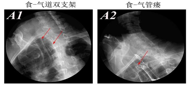 消化科運(yùn)用多學(xué)科會診（MDT）微創(chuàng)診治食管惡性腫瘤侵潤所致食、氣道梗阻(圖8)